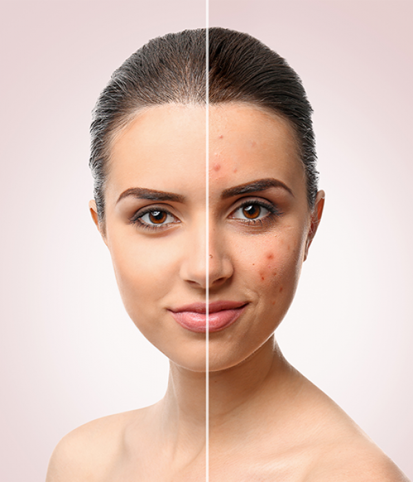 Qual è la verità sull’acne?