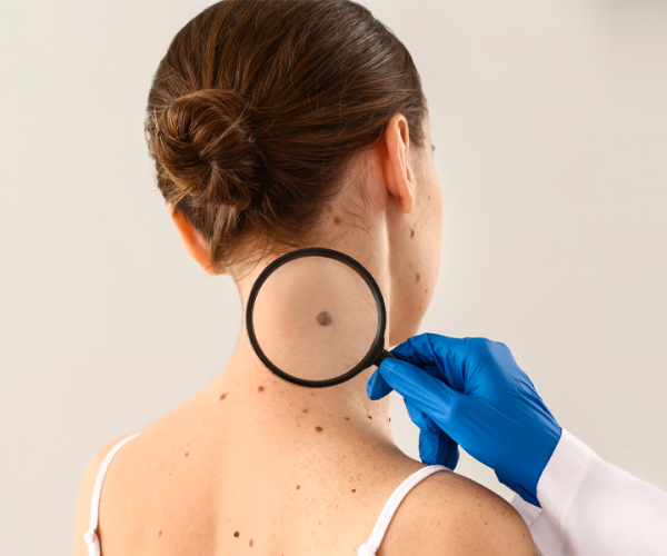 Scienza: la diagnosi di precisione in caso di melanoma.